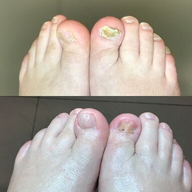 Esperientzia Israelgo eskumuturreko promigiloa erabiltzeko, argazkia aurretik eta ondoren