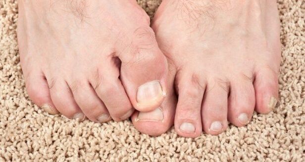 Iltze onddoaren sintomak