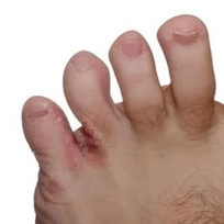 hatzekin arteko onddoa