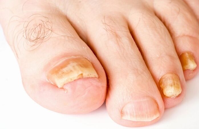 Onddoa hankaren gainean