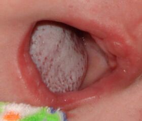 Gaixotasuna onddo batekin lokalizatzea