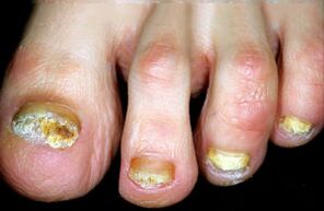 Gaixotasunaren karakterizazioa