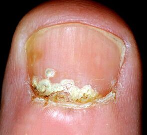 Gaixotasunaren sintomak eta seinaleak