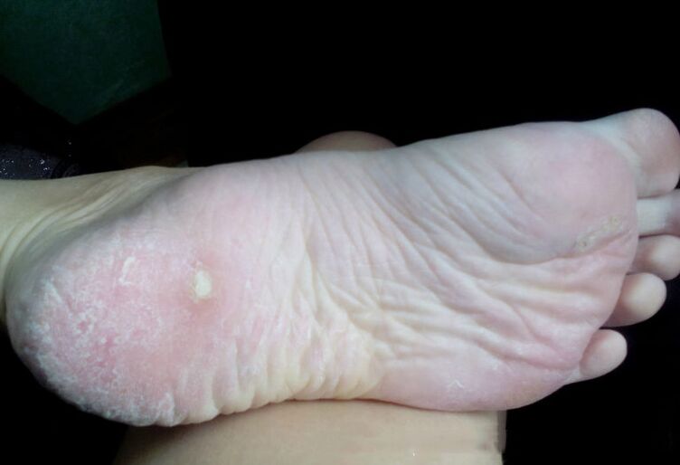 Onddoaren tratamendua laser batekin