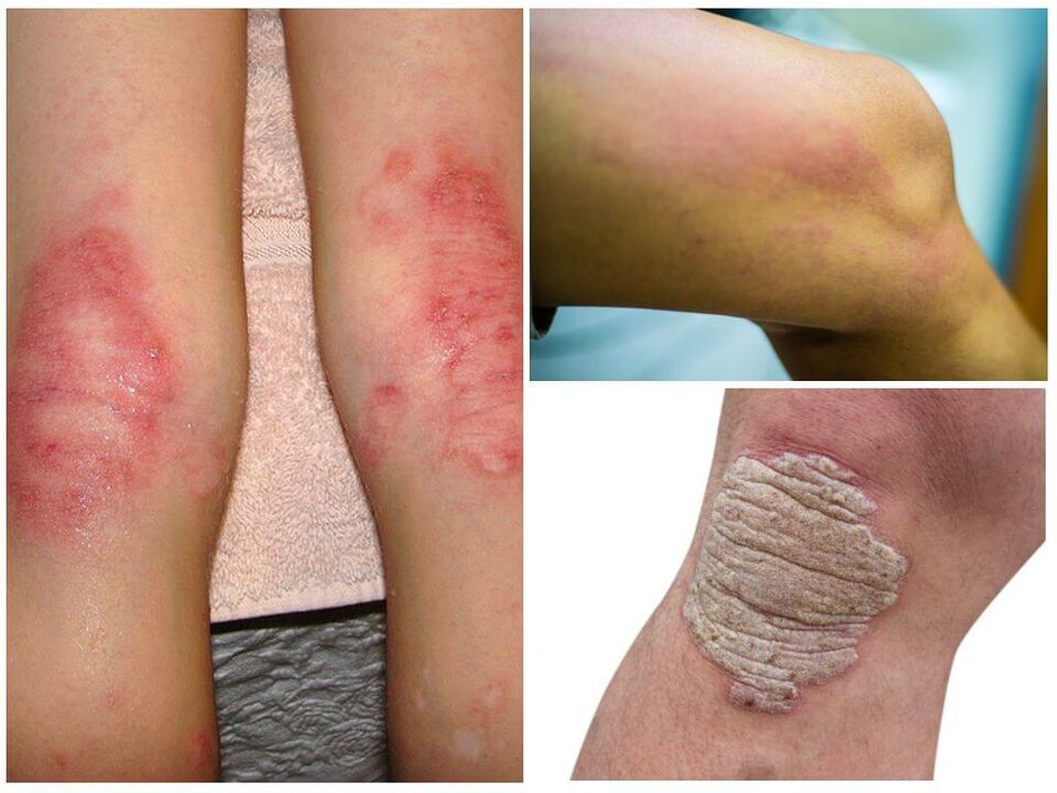 Belaunetako onddoen infekzioak