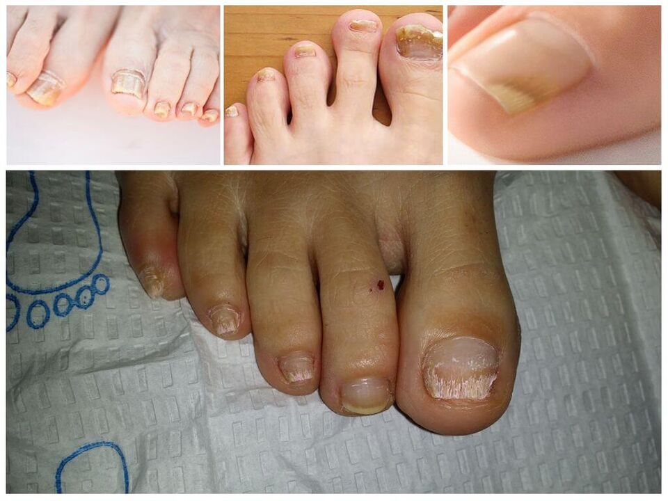 Iltze-plaken onddoen gaixotasunak