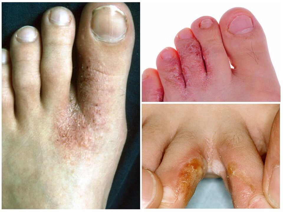 Mikosi interdigitala