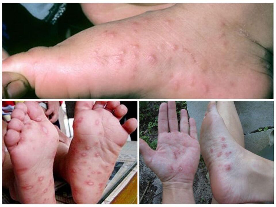 Oinetako lesio hiperkeratotikoak