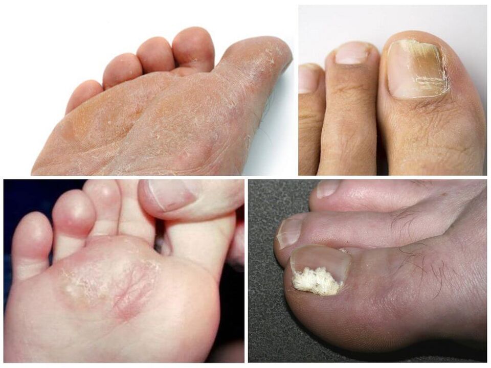 Oinetako onddoaren hasierako fasea