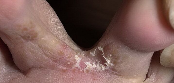 behatz arteko onddoa