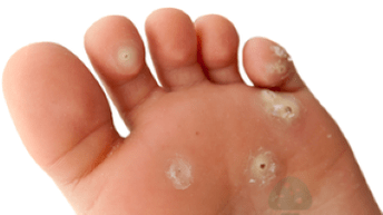 onddoen infekzioaren bigarren fasea